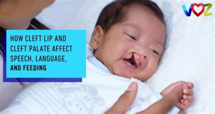 How does cleft palate affect speech