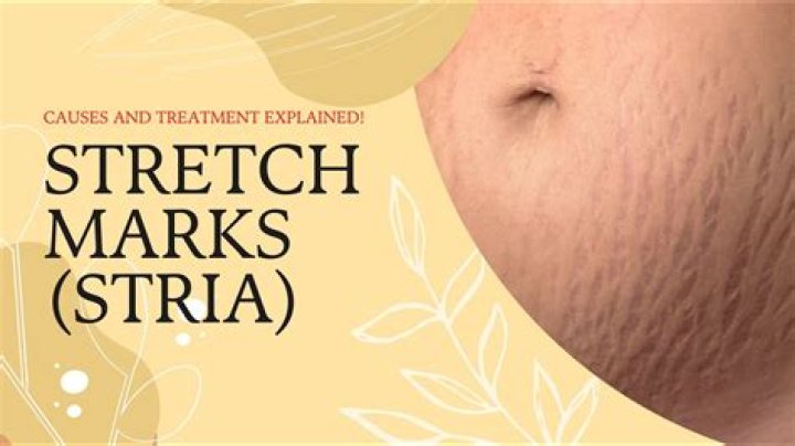 Is it bad for a teenager to have stretch marks?