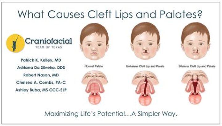 What causes a cleft palate