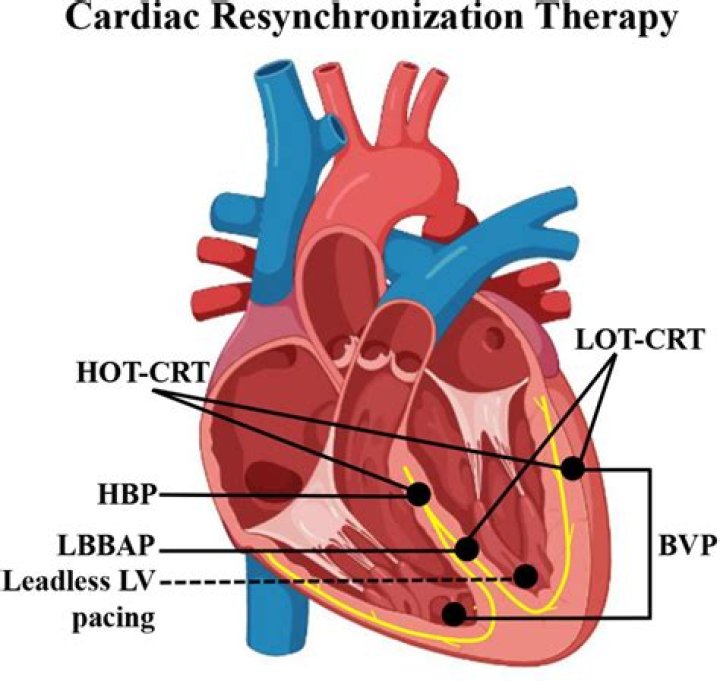 What is cardiac PCU