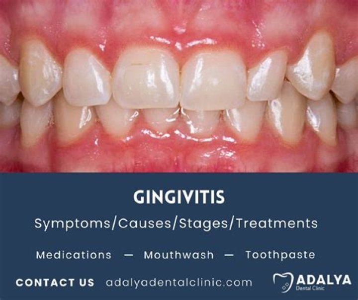 What is chronic Generalised gingivitis